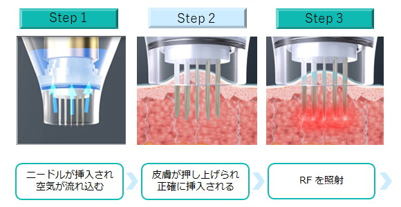 ボリュームアップ流れ